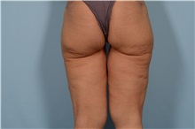 Thigh Lift Before Photo by Ellen Janetzke, MD; Bloomfield Hills, MI - Case 49316