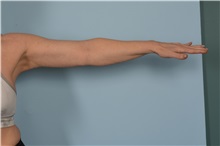 Arm Lift After Photo by Ellen Janetzke, MD; Bloomfield Hills, MI - Case 49303