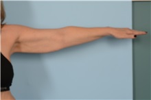 Arm Lift Before Photo by Ellen Janetzke, MD; Bloomfield Hills, MI - Case 49303