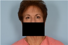 Eyelid Surgery After Photo by Ellen Janetzke, MD; Bloomfield Hills, MI - Case 49304