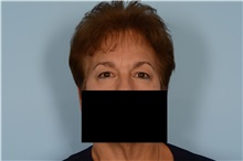 Eyelid Surgery Before Photo by Ellen Janetzke, MD; Bloomfield Hills, MI - Case 49304