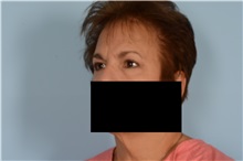 Eyelid Surgery After Photo by Ellen Janetzke, MD; Bloomfield Hills, MI - Case 49304