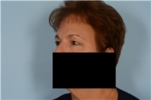 Eyelid Surgery Before Photo by Ellen Janetzke, MD; Bloomfield Hills, MI - Case 49304