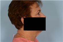 Eyelid Surgery After Photo by Ellen Janetzke, MD; Bloomfield Hills, MI - Case 49304