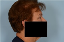 Eyelid Surgery Before Photo by Ellen Janetzke, MD; Bloomfield Hills, MI - Case 49304