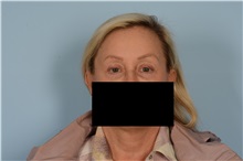 Eyelid Surgery After Photo by Ellen Janetzke, MD; Bloomfield Hills, MI - Case 49301