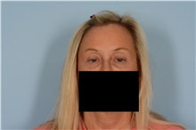 Eyelid Surgery Before Photo by Ellen Janetzke, MD; Bloomfield Hills, MI - Case 49301