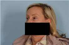 Eyelid Surgery After Photo by Ellen Janetzke, MD; Bloomfield Hills, MI - Case 49301