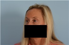 Eyelid Surgery Before Photo by Ellen Janetzke, MD; Bloomfield Hills, MI - Case 49301