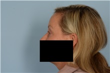 Eyelid Surgery After Photo by Ellen Janetzke, MD; Bloomfield Hills, MI - Case 49301