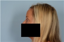 Eyelid Surgery Before Photo by Ellen Janetzke, MD; Bloomfield Hills, MI - Case 49301