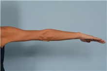 Arm Lift After Photo by Ellen Janetzke, MD; Bloomfield Hills, MI - Case 49503