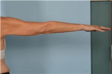 Arm Lift Before Photo by Ellen Janetzke, MD; Bloomfield Hills, MI - Case 49503