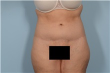 Tummy Tuck After Photo by Ellen Janetzke, MD; Bloomfield Hills, MI - Case 49501