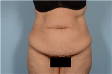 Tummy Tuck Before Photo by Ellen Janetzke, MD; Bloomfield Hills, MI - Case 49501