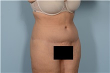 Tummy Tuck After Photo by Ellen Janetzke, MD; Bloomfield Hills, MI - Case 49501