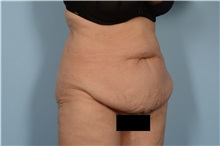 Tummy Tuck Before Photo by Ellen Janetzke, MD; Bloomfield Hills, MI - Case 49501