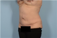 Liposuction After Photo by Ellen Janetzke, MD; Bloomfield Hills, MI - Case 49504