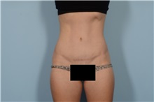 Tummy Tuck After Photo by Ellen Janetzke, MD; Bloomfield Hills, MI - Case 49617