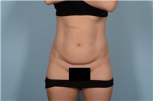 Tummy Tuck Before Photo by Ellen Janetzke, MD; Bloomfield Hills, MI - Case 49617