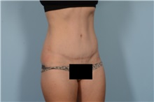 Tummy Tuck After Photo by Ellen Janetzke, MD; Bloomfield Hills, MI - Case 49617