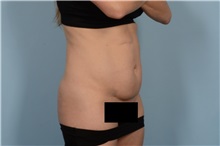 Tummy Tuck Before Photo by Ellen Janetzke, MD; Bloomfield Hills, MI - Case 49617