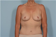 Breast Lift After Photo by Ellen Janetzke, MD; Bloomfield Hills, MI - Case 49832 Breast Lift After Photo by Ellen Janetzke, MD; Bloomfield Hills, MI - Case 49832