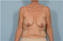 Breast Lift Before Photo by Ellen Janetzke, MD; Bloomfield Hills, MI - Case 49832 Breast Lift Before Photo by Ellen Janetzke, MD; Bloomfield Hills, MI - Case 49832