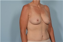 Breast Lift After Photo by Ellen Janetzke, MD; Bloomfield Hills, MI - Case 49832