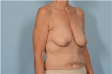 Breast Lift Before Photo by Ellen Janetzke, MD; Bloomfield Hills, MI - Case 49832