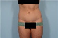 Tummy Tuck After Photo by Ellen Janetzke, MD; Bloomfield Hills, MI - Case 49829