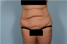 Tummy Tuck Before Photo by Ellen Janetzke, MD; Bloomfield Hills, MI - Case 49829