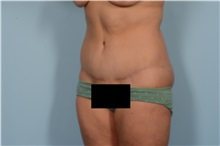 Tummy Tuck After Photo by Ellen Janetzke, MD; Bloomfield Hills, MI - Case 49829