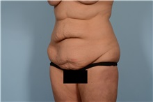 Tummy Tuck Before Photo by Ellen Janetzke, MD; Bloomfield Hills, MI - Case 49829