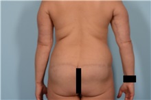 Body Lift After Photo by Ellen Janetzke, MD; Bloomfield Hills, MI - Case 49830 Body Lift After Photo by Ellen Janetzke, MD; Bloomfield Hills, MI - Case 49830