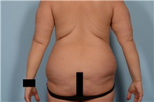 Body Lift Before Photo by Ellen Janetzke, MD; Bloomfield Hills, MI - Case 49830 Body Lift Before Photo by Ellen Janetzke, MD; Bloomfield Hills, MI - Case 49830