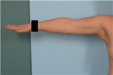 Arm Lift After Photo by Ellen Janetzke, MD; Bloomfield Hills, MI - Case 49828 Arm Lift After Photo by Ellen Janetzke, MD; Bloomfield Hills, MI - Case 49828
