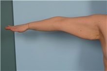 Arm Lift Before Photo by Ellen Janetzke, MD; Bloomfield Hills, MI - Case 49828 Arm Lift Before Photo by Ellen Janetzke, MD; Bloomfield Hills, MI - Case 49828
