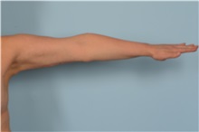 Arm Lift After Photo by Ellen Janetzke, MD; Bloomfield Hills, MI - Case 49828