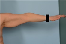 Arm Lift Before Photo by Ellen Janetzke, MD; Bloomfield Hills, MI - Case 49828