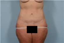 Tummy Tuck After Photo by Ellen Janetzke, MD; Bloomfield Hills, MI - Case 49831 Tummy Tuck After Photo by Ellen Janetzke, MD; Bloomfield Hills, MI - Case 49831