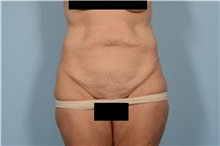 Tummy Tuck Before Photo by Ellen Janetzke, MD; Bloomfield Hills, MI - Case 49831 Tummy Tuck Before Photo by Ellen Janetzke, MD; Bloomfield Hills, MI - Case 49831