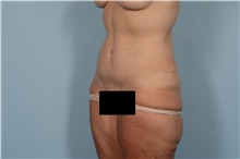 Tummy Tuck After Photo by Ellen Janetzke, MD; Bloomfield Hills, MI - Case 49831