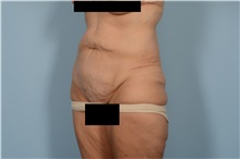 Tummy Tuck Before Photo by Ellen Janetzke, MD; Bloomfield Hills, MI - Case 49831