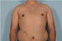 Male Breast Reduction After Photo by Ellen Janetzke, MD; Bloomfield Hills, MI - Case 49870 Male Breast Reduction After Photo by Ellen Janetzke, MD; Bloomfield Hills, MI - Case 49870