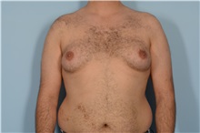 Male Breast Reduction Before Photo by Ellen Janetzke, MD; Bloomfield Hills, MI - Case 49870 Male Breast Reduction Before Photo by Ellen Janetzke, MD; Bloomfield Hills, MI - Case 49870