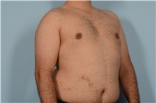 Male Breast Reduction After Photo by Ellen Janetzke, MD; Bloomfield Hills, MI - Case 49870