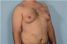 Male Breast Reduction Before Photo by Ellen Janetzke, MD; Bloomfield Hills, MI - Case 49870