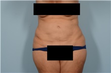 Liposuction After Photo by Ellen Janetzke, MD; Bloomfield Hills, MI - Case 50077