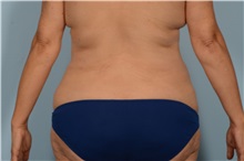 Liposuction After Photo by Ellen Janetzke, MD; Bloomfield Hills, MI - Case 50079